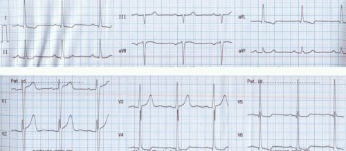 Left ventricular hypertrophy