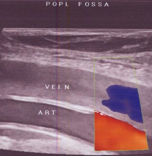 colour-doppler-of-popliteal-artery-and-vein-small Colour Doppler image of popliteal artery and vein