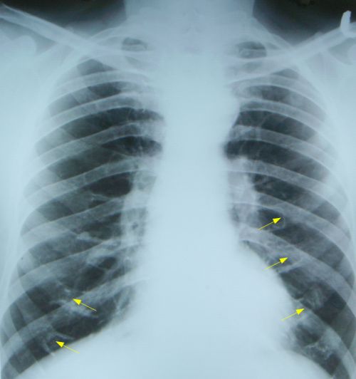 Costal cartilage calcification in male Costal cartilage calcification in male