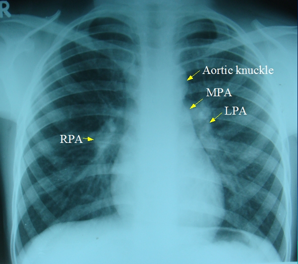 normal-x-ray-chest Normal X-ray chest PA
