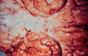 haemophilus influenzae_meningitis_5003_lores
