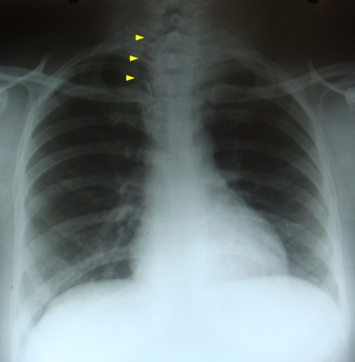 tracheal-shift-to-right-due-to-thyroid-swelling Tracheal shift to right due to thyroid swelling