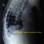Anterior wedge compression fracture – Xray