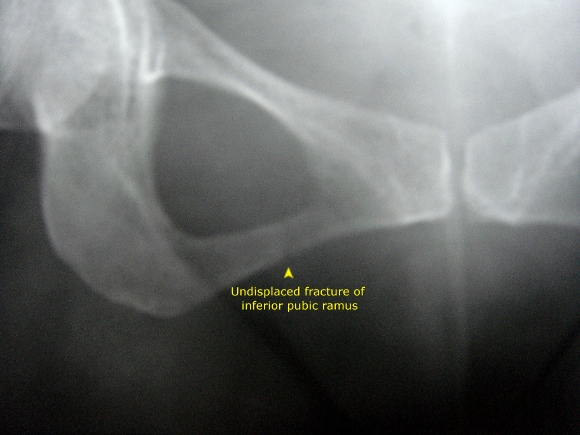 Undisplaced fracture – Inferior pubic ramus